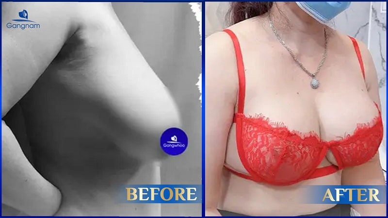Ngực bên to bên nhỏ - Nguyên nhân và cách khắc phục 8 Ngực bên to bên nhỏ