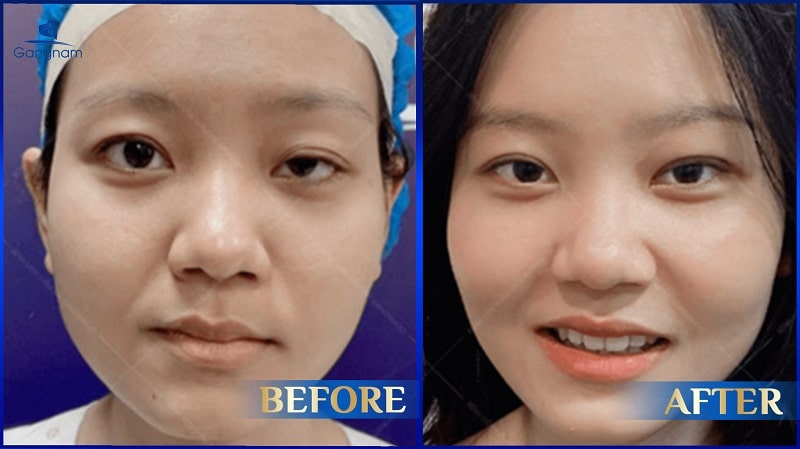 Nhược cơ nâng mi là gì? Nguyên nhân và cách khắc phục hiệu quả 8 Nhược cơ nâng mi