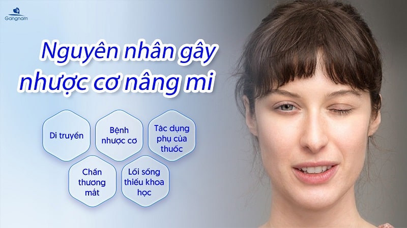 Nhược cơ nâng mi là gì? Nguyên nhân và cách khắc phục hiệu quả 6 Nhược cơ nâng mi