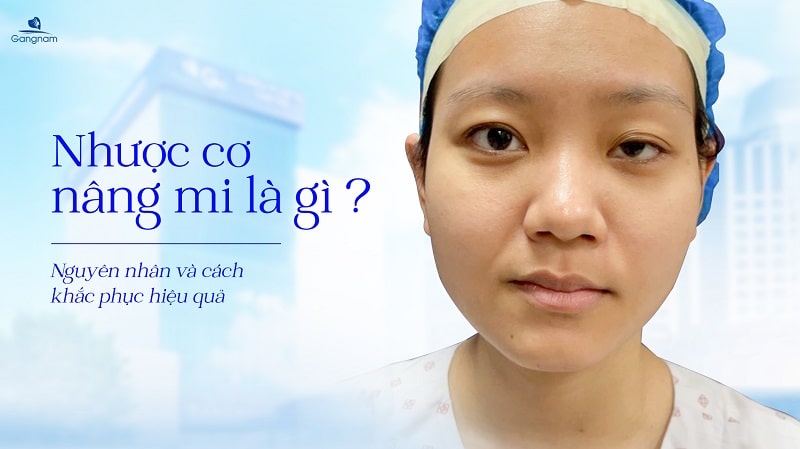 Nhược cơ nâng mi là gì? Nguyên nhân và cách khắc phục hiệu quả 5 Nhược cơ nâng mi