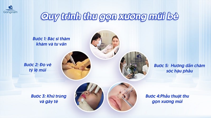 Thu gọn xương mũi bè và những lưu ý không nên bỏ qua 7 Thu gọn xương mũi bè