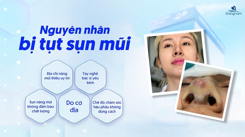 Tụt sụn mũi - Dấu hiệu, nguyên nhân và cách khắc phục 5 Tụt sụn mũi