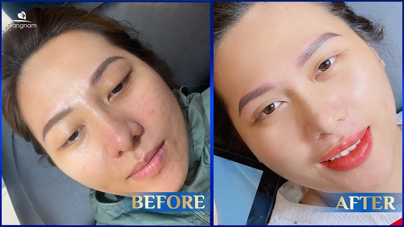 Viền môi bị thâm sau khi xăm phải làm sao? 6 Viền môi bị thâm sau khi xăm
