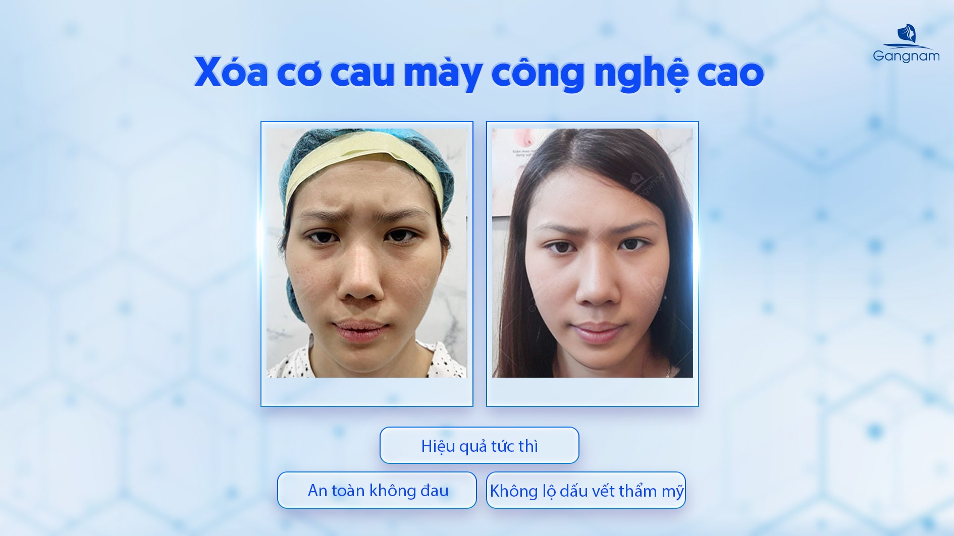 Xóa cơ cau mày - Bí quyết lấy lại gương mặt tươi trẻ 7 Xóa cơ cau mày
