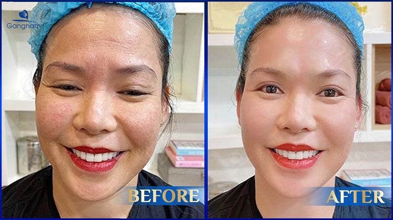 Xóa cơ cau mày - Bí quyết lấy lại gương mặt tươi trẻ 8 Xóa cơ cau mày