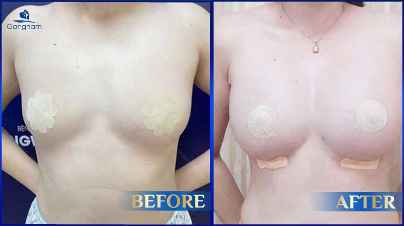 50 tuổi có nên nâng ngực không? 6 50 tuổi có nên nâng ngực không?