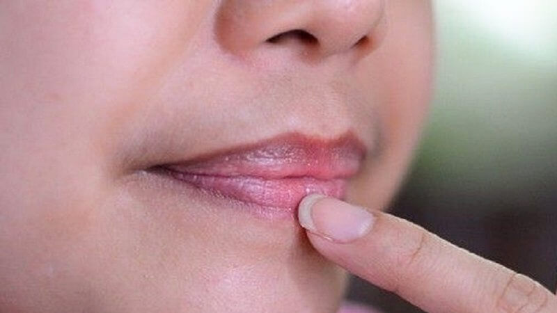Cách trị thâm mép môi tại nhà hiệu quả nhất 6 Cách trị thâm mép môi