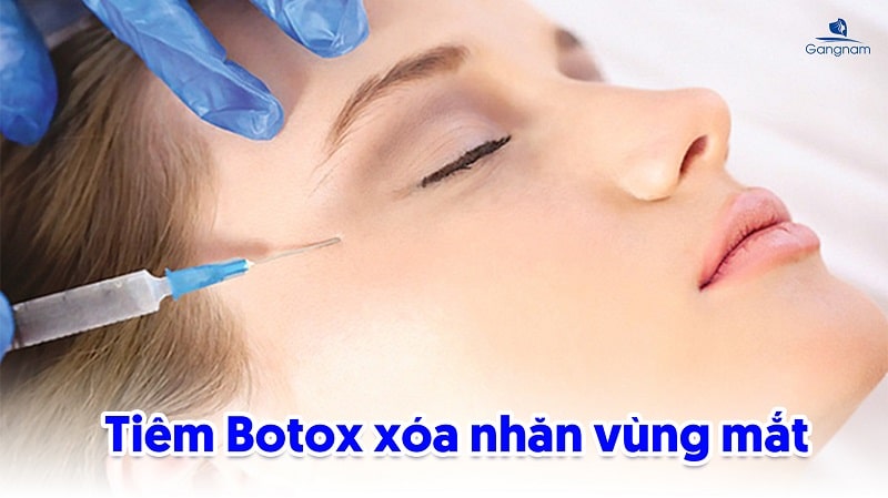 Cách xóa nếp nhăn vùng mắt hiệu quả 8 Cách xóa nếp nhăn vùng mắt