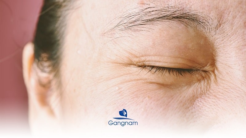 Cách xóa nếp nhăn vùng mắt hiệu quả 6 Cách xóa nếp nhăn vùng mắt