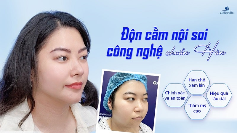 Độn cằm nội soi - Công nghệ tạo cằm VLine an toàn, hiệu quả cao 6 Độn cằm nội soi