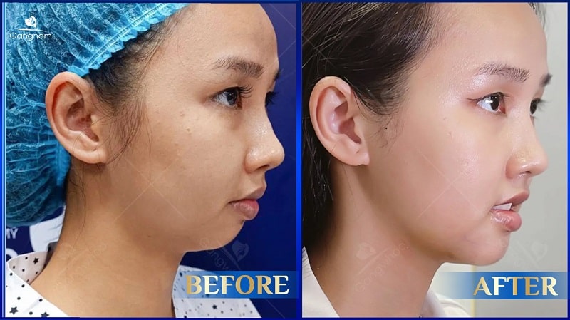 Độn cằm nội soi - Công nghệ tạo cằm VLine an toàn, hiệu quả cao 8 Độn cằm nội soi