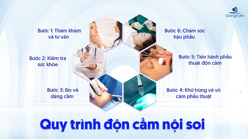Độn cằm nội soi - Công nghệ tạo cằm VLine an toàn, hiệu quả cao 7 Độn cằm nội soi