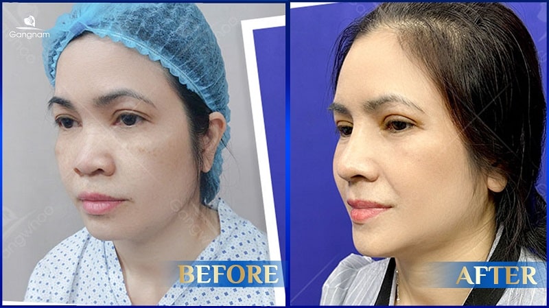 Mũi ngắn là gì? Tướng số mũi ngắn như thế nào? 8 Mũi ngắn là gì?