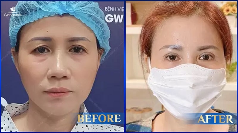 Nâng cung chân mày nội soi - Níu giữ nét thanh xuân cho gương mặt 8 Nâng cung chân mày nội soi