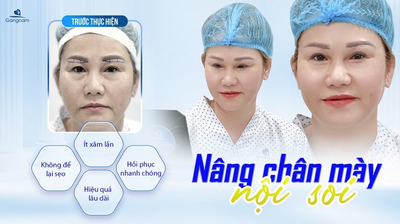 Nâng cung chân mày nội soi - Níu giữ nét thanh xuân cho gương mặt 6 Nâng cung chân mày nội soi