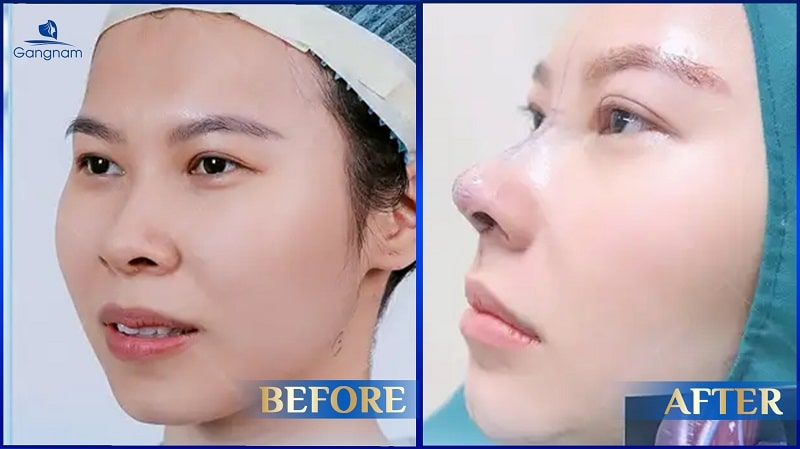 Nâng mũi sụn sinh học là gì? Có nên thực hiện không? 8 Nâng mũi sụn sinh học