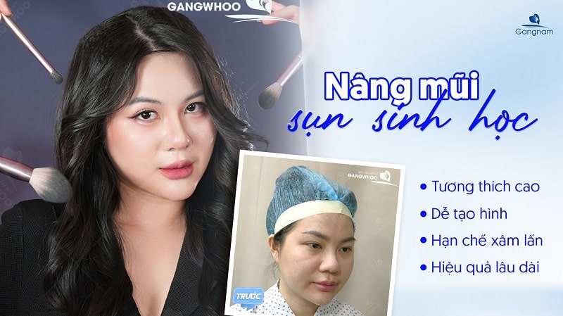 Nâng mũi sụn sinh học là gì? Có nên thực hiện không? 6 Nâng mũi sụn sinh học