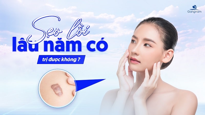 Sẹo lồi lâu năm có trị được không? 5 Sẹo lồi lâu năm có trị được không?