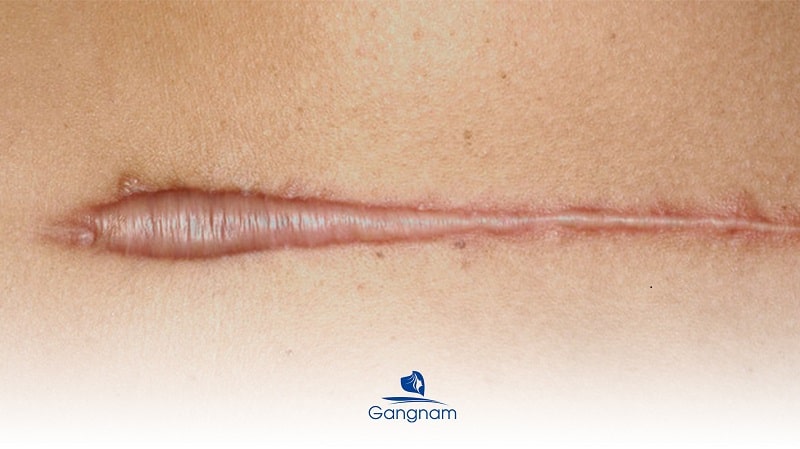 Sẹo lồi lâu năm có trị được không? 6 Sẹo lồi lâu năm có trị được không?