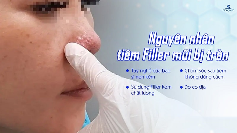 Tiêm Filler mũi bị tràn có nguy hiểm không? 5 Tiêm Filler mũi bị tràn