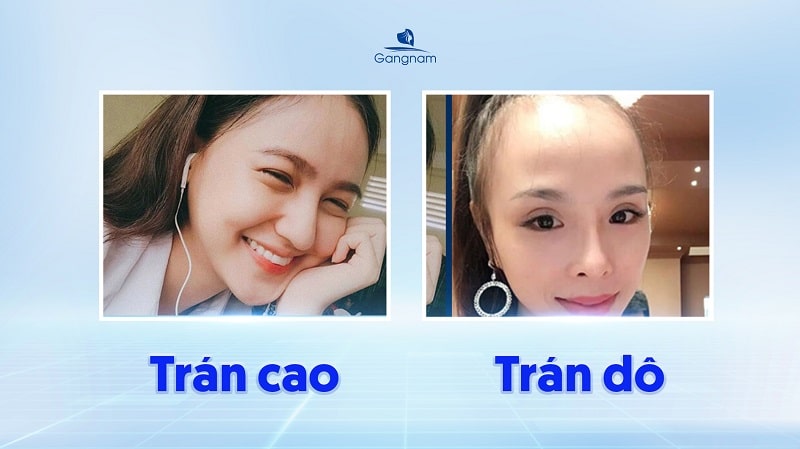 Trán dô là gì? Tướng số tốt hay xấu? 6 Trán dô là gì?