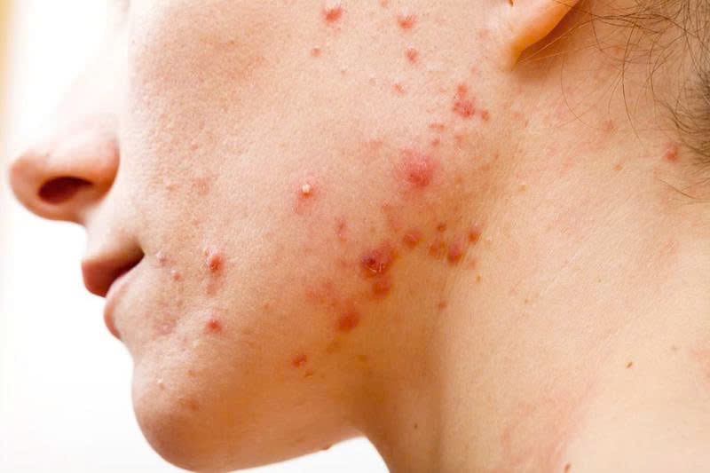 Cách trị mụn mủ tại nhà bằng các nguyên liệu tự nhiên 6 Cách trị mụn mủ