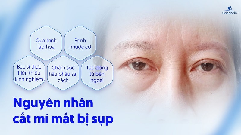 Cắt mí có bị sụp lại không? 5 Cắt mí có bị sụp lại không?