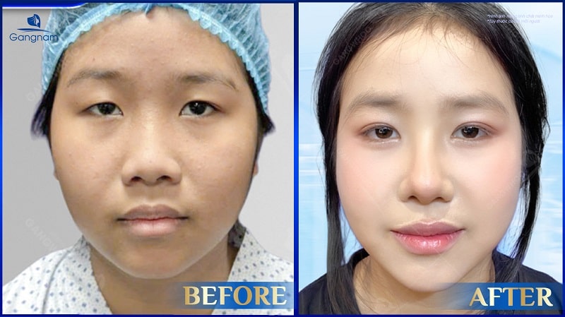 Cắt mí có bị sụp lại không? 6 Cắt mí có bị sụp lại không?