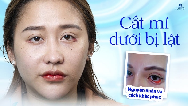Cắt mí dưới bị lật phải làm sao? 5 Cắt mí dưới bị lật