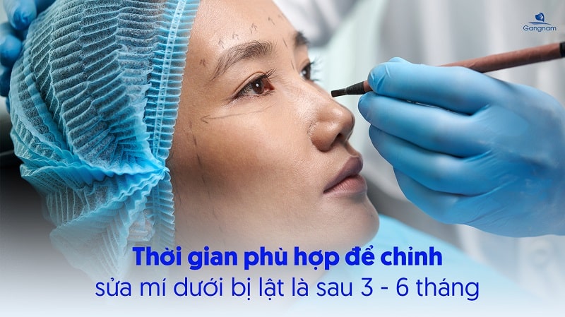 Cắt mí dưới bị lật phải làm sao? 7 Cắt mí dưới bị lật