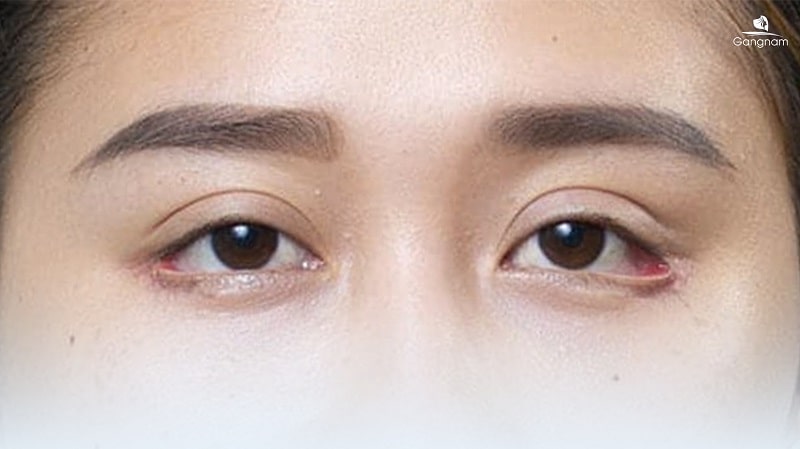 Cắt mí dưới bị lật phải làm sao? 6 Cắt mí dưới bị lật