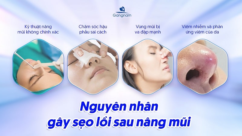 Cơ địa sẹo lồi nâng mũi được không? 6 Cơ địa sẹo lồi nâng mũi được không?
