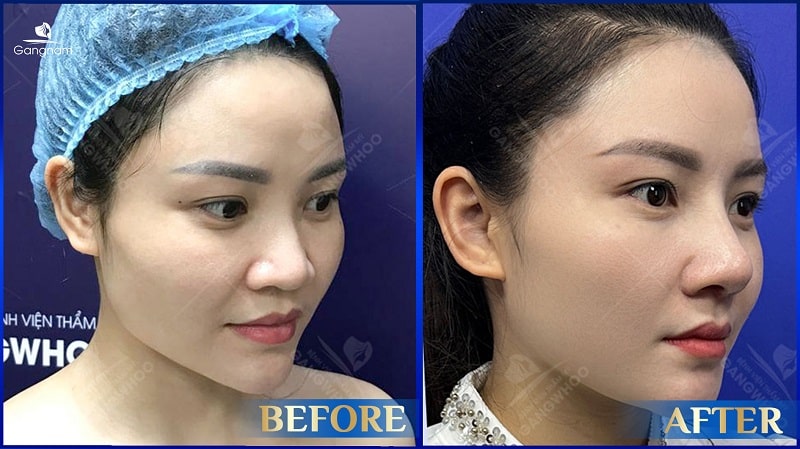 Nâng mũi bao lâu thì được ngoáy mũi? 6 Cơ địa sẹo lồi nâng mũi được không?