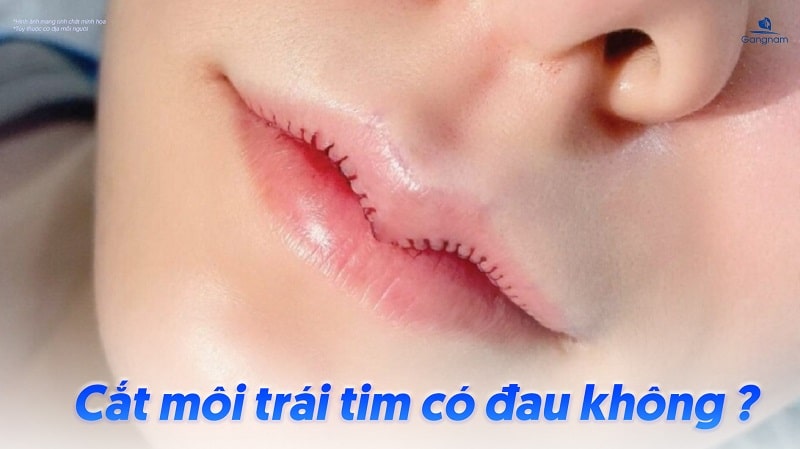 Có nên cắt môi trái tim không? 7 Có nên cắt môi trái tim không?