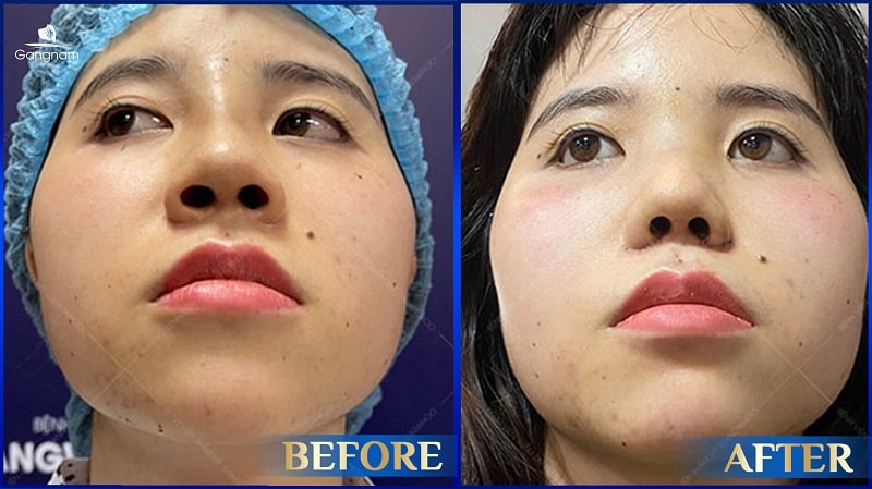 Cuộn cánh mũi là gì? Có vĩnh viễn không? 8 Cuộn cánh mũi