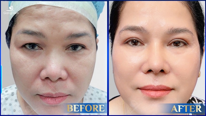 Phụ nữ đến tháng có cắt mí được không? 6 Đến tháng có cắt mí được không?