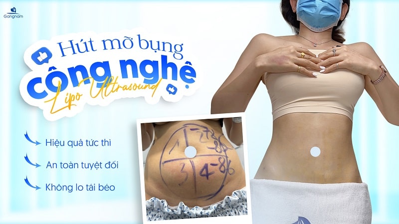 Hút mỡ bụng có bị béo lại không? 6 Hút mỡ bụng có bị béo lại không?