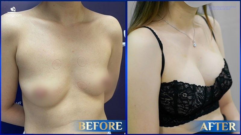 Nâng ngực giọt nước - Phương pháp thẩm mỹ vòng 1 an toàn, tự nhiên 8 Nâng ngực bị lộ túi