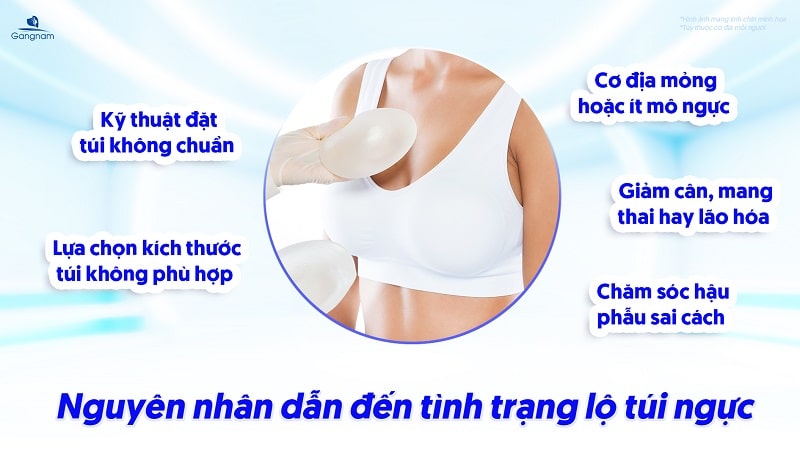Nâng ngực bị lộ túi - Nguyên nhân và cách khắc phục 5 Nâng ngực bị lộ túi