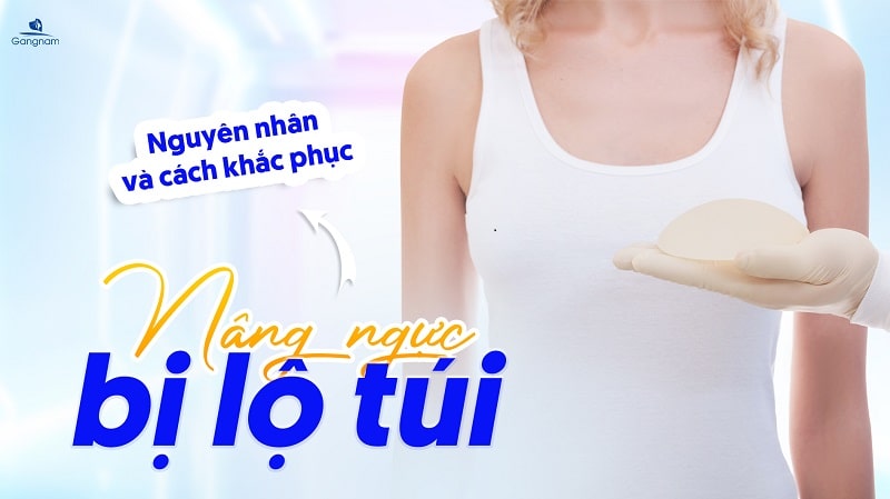 Nâng ngực bị lộ túi - Nguyên nhân và cách khắc phục 4 Nâng ngực bị lộ túi