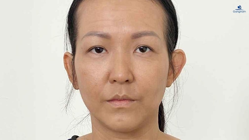 Thái dương hóp - Nguyên nhân và cách khắc phục hiệu quả 6 Thái dương hóp