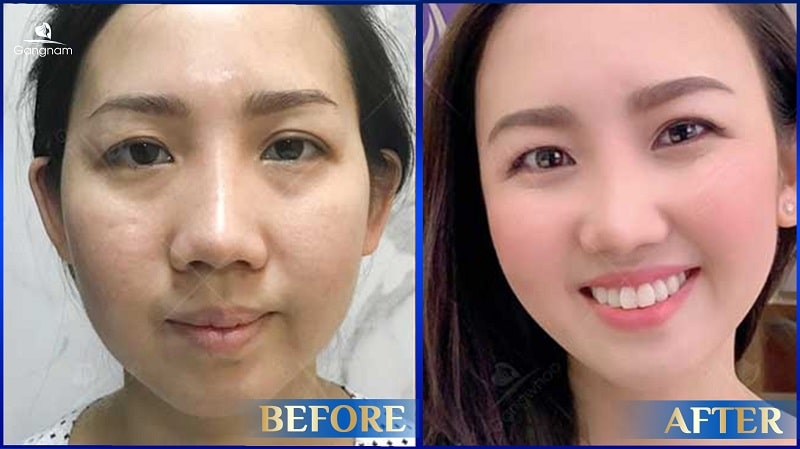 Thái dương hóp - Nguyên nhân và cách khắc phục hiệu quả 8 Thái dương hóp