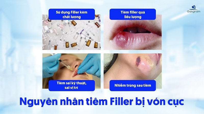 Tiêm Filler bị vón cục có nguy hiểm không? 6 Tiêm Filler bị vón cục