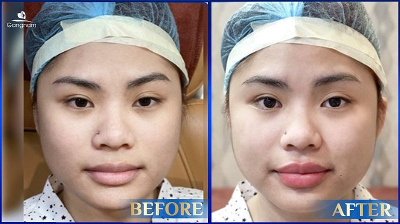Tiêm Filler bị vón cục có nguy hiểm không? 8 Tiêm Filler bị vón cục