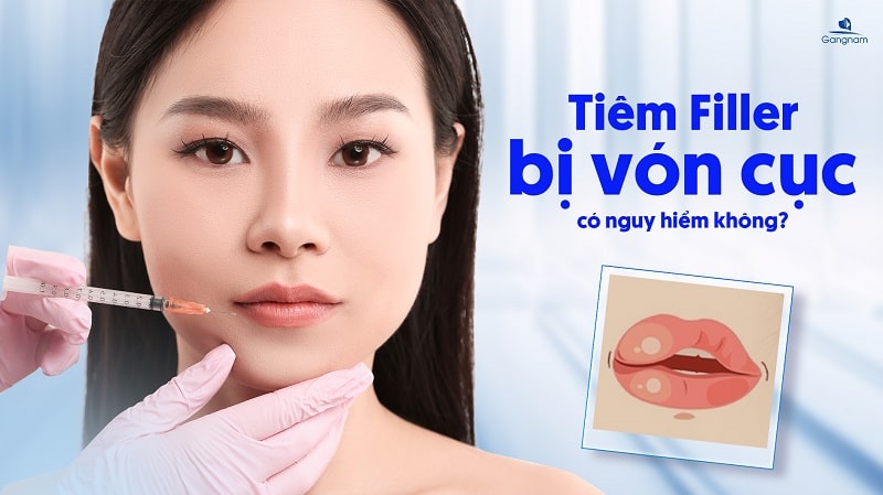 Tiêm Filler bị vón cục có nguy hiểm không? 5 Tiêm Filler bị vón cục