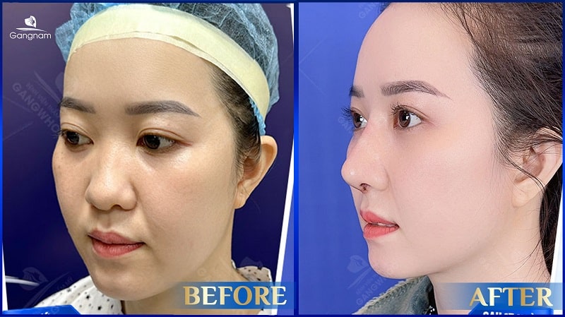 Tụ dịch sau nâng mũi - Dấu hiệu nhận biết, nguyên nhân và cách khắc phục 8 Tụ dịch sau nâng mũi