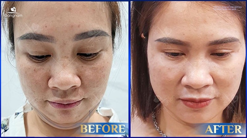 Hút mỡ nọng cằm có nguy hiểm không? 8 Hút mỡ nọng cằm có nguy hiểm không?