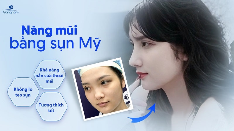 Nâng mũi sụn Mỹ có tốt không? 6 Nâng mũi sụn Mỹ