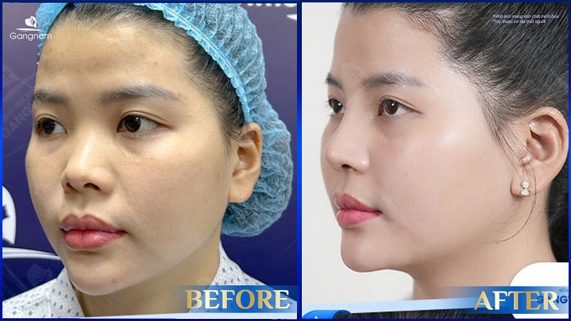 Nâng mũi sụn Mỹ có tốt không? 8 Nâng mũi sụn Mỹ
