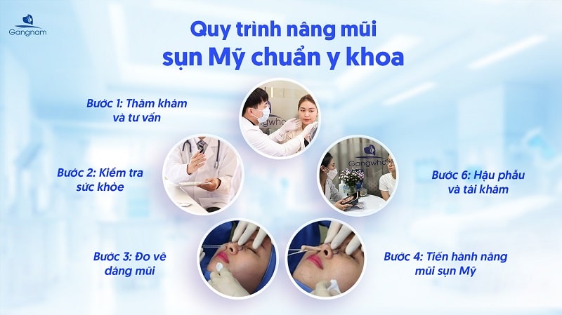 Nâng mũi sụn Mỹ có tốt không? 7 Nâng mũi sụn Mỹ